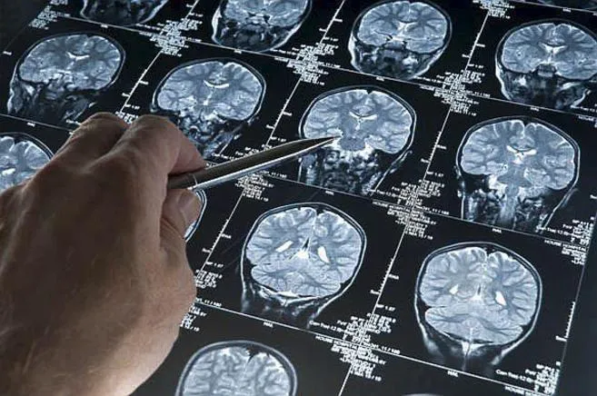 {'en': 'The double bond that joins diabetes and dementia', 'es': 'El doble lazo que une diabetes y demencia'} Image