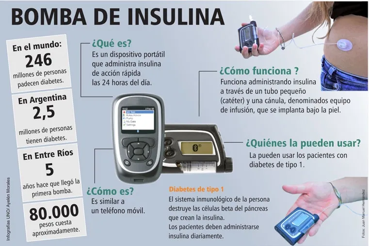 {'en': 'The insulin bomb changes the life of people with diabetes (Argentina)', 'es': 'La bomba de insulina cambia la vida a personas con diabetes (Argentina)'} Image