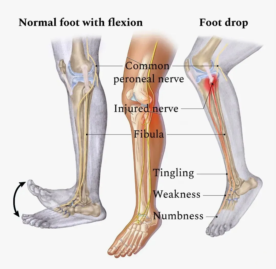 {'en': 'Fallen foot (peroneal nerve neuropathy)', 'es': 'Pie caído (neuropatía del nervio peroneo)'} Image