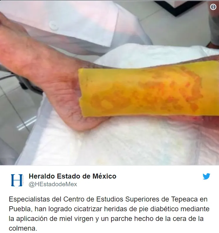 {'en': 'The revolutionary honey patch to avoid amputations in patients with diabetes', 'es': 'El revolucionario parche de miel para evitar amputaciones en pacientes con diabetes'} Image