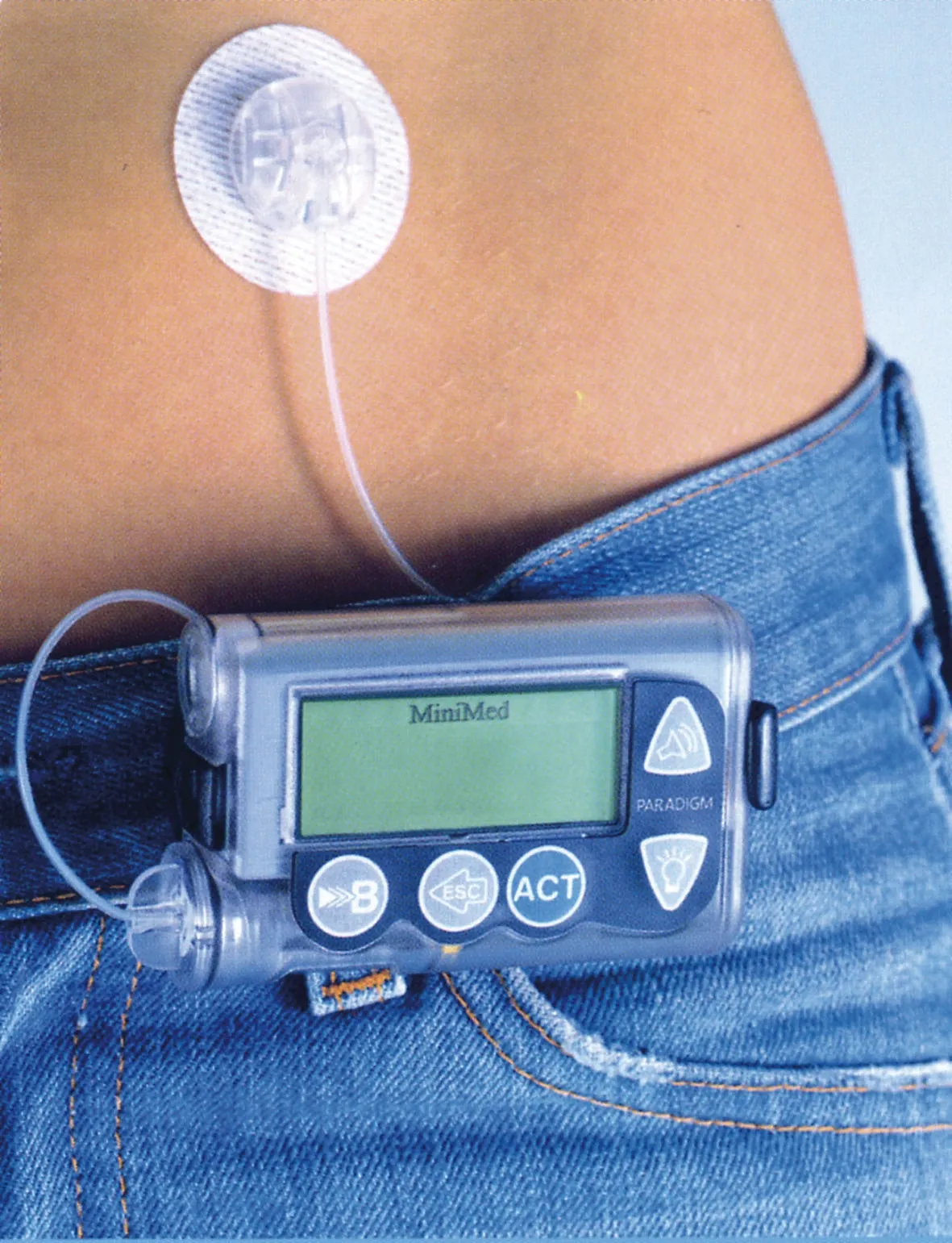 {'en': 'Insulin pump cateter obstruction', 'es': 'Obstrucción cateter bomba de insulina'} Image