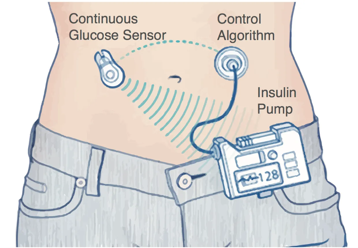 {'en': 'The artificial pancreas is safe in type 1 diabetes', 'es': 'El páncreas artificial es seguro en la diabetes tipo 1'} Image