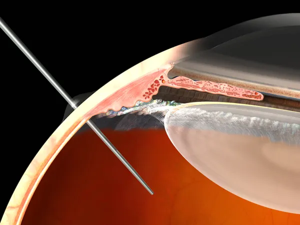 {'en': 'Have anyone put intravitrea injection?', 'es': '¿A alguien le han puesto la Inyección Intravitrea?'} Image