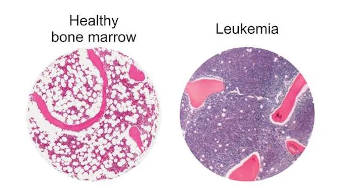 {'en': 'A drug for diabetes helps fight leukemia', 'es': 'Un fármaco para la diabetes ayuda a combatir la leucemia'} Image