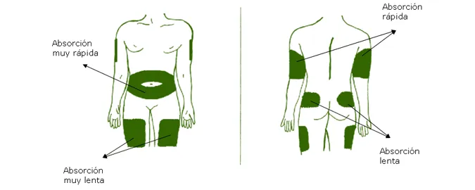 {'en': 'Where insulin should be injected', 'es': 'Donde se debe inyectar la insulina'} Image