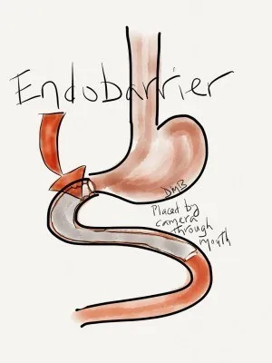 {'en': 'Gi Dynamics suspends CE marking from Endobarrier, its endoscopic device for diabetes', 'es': 'GI Dynamics suspende el marcado CE de EndoBarrier, su dispositivo endoscópico para la diabetes'} Image