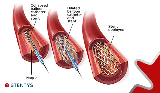 {'en': "Diabetes control guarantees better cardiovascular health to people with 'stent'", 'es': "El control de la diabetes garantiza una mejor salud cardiovascular a las personas con 'stent'"} Image