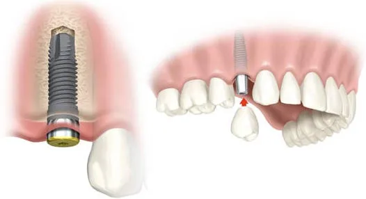 {'en': 'Diabetes and dental implants', 'es': 'Diabetes y los implantes dentales'} Image