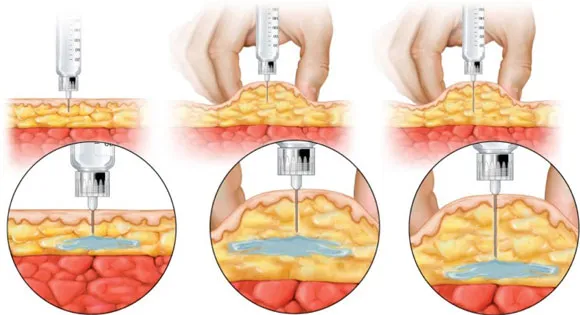 {'en': 'How to inject insulin correctly?', 'es': 'Cómo inyectar la insulina correctamente?'} Image