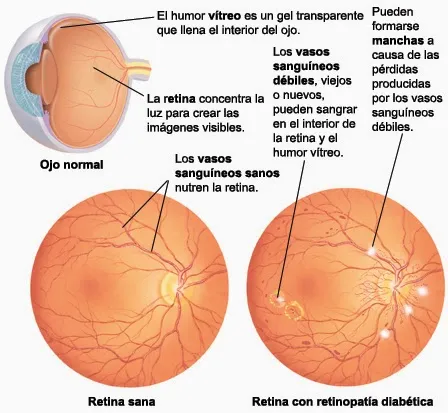 {'en': 'Proliferative Diabetic Retinopathy (RDP)', 'es': 'Retinopatía Diabética Proliferativa (RDP)'} Image