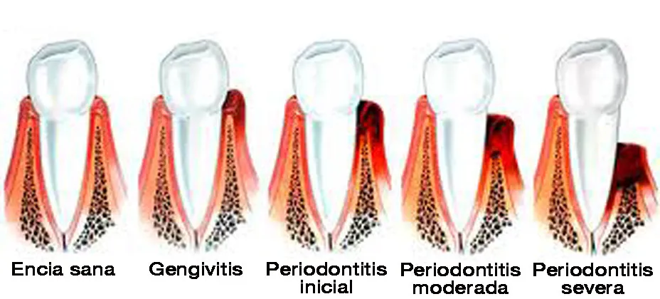 {'en': 'Advanced periodontitis synonym for poorly controlled diabetes', 'es': 'Una periodontitis avanzada sinónimo de diabetes mal controlada'} Image