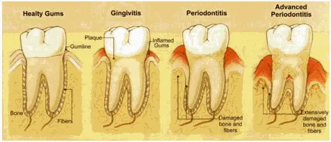 {'en': 'Periodontitis could be an early sign of non -diagnosed diabetes', 'es': 'La periodontitis podría ser un signo precoz de una diabetes no diagnosticada'} Image