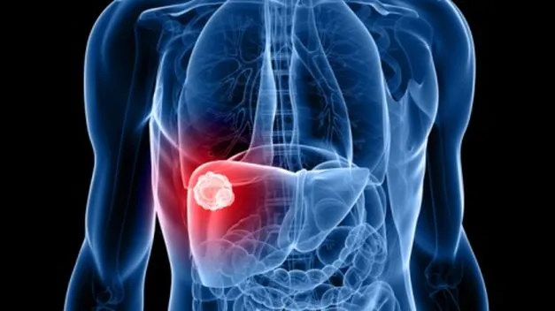 {'en': 'Obesity and diabetes greatly increase the risk of liver cancer', 'es': 'La obesidad y la diabetes aumentan mucho el riesgo de cáncer de hígado'} Image