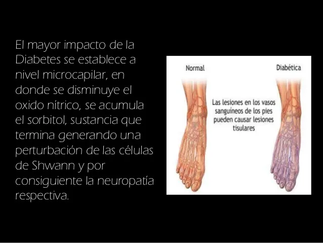 {'en': 'Neurological damage and diabetes', 'es': 'Daño neurológico y diabetes'} Image